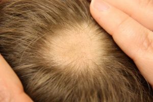 types of female hair loss