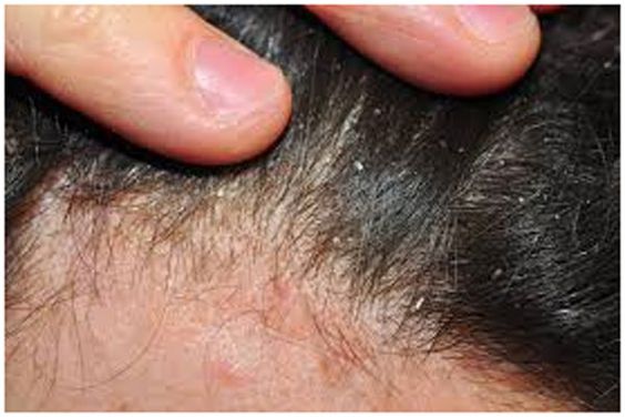 what is the best scalp psoriasis shampoo-type ?