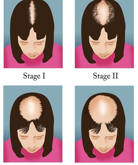 Female Hair Loss & Pattern Baldness in Women