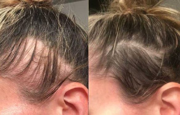 Treat Hair Loss At The Temples