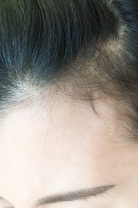 doctor treats hair loss