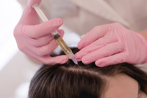 PRP Injections Can Regrow Hair